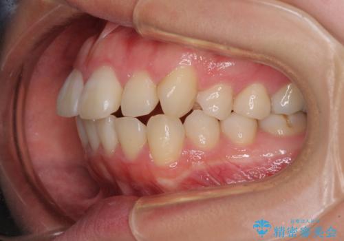 口元の突出感を抜歯矯正で改善　メタル装置で費用を抑えるの治療前