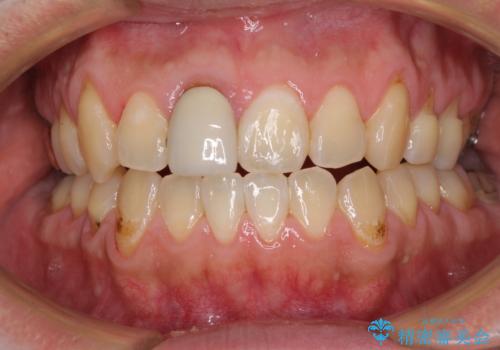 前歯のデコボコとクロスバイトをインビザライン矯正で改善の治療中
