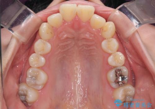 口元の突出感を抜歯矯正で改善 メタル装置で費用を抑えるの治療前