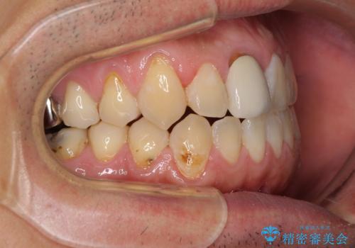 前歯のデコボコとクロスバイトをインビザライン矯正で改善の治療中