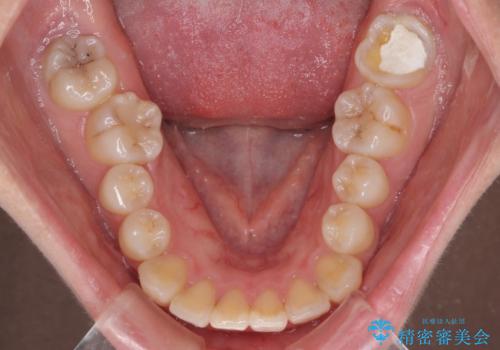 口元の突出感を抜歯矯正で改善 メタル装置で費用を抑えるの治療前