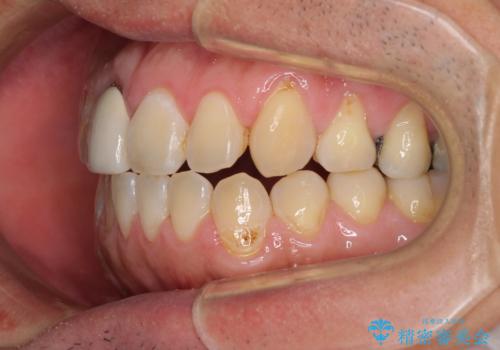 前歯のデコボコとクロスバイトをインビザライン矯正で改善の治療中