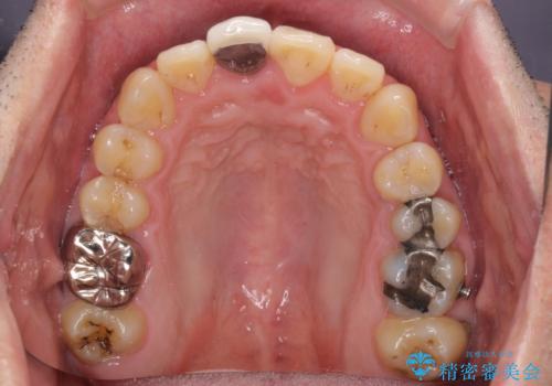 前歯のデコボコとクロスバイトをインビザライン矯正で改善の治療中