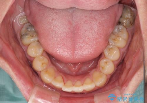 前歯のデコボコとクロスバイトをインビザライン矯正で改善の治療中