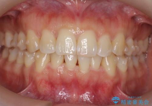 下の前歯のがたつき インビザラインでの治療中