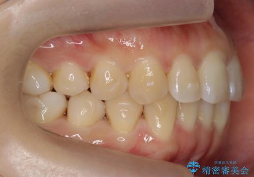下の前歯のがたつき インビザラインでの治療中