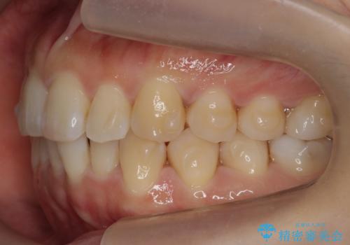 下の前歯のがたつき インビザラインでの治療中