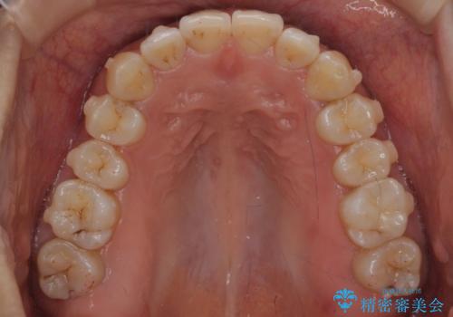 下の前歯のがたつき インビザラインでの治療中