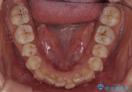 下の前歯のがたつき インビザラインでの治療中