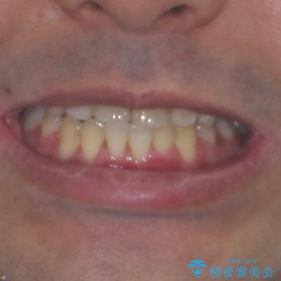 デコボコを治したい　八重歯の抜歯矯正の治療後（顔貌）
