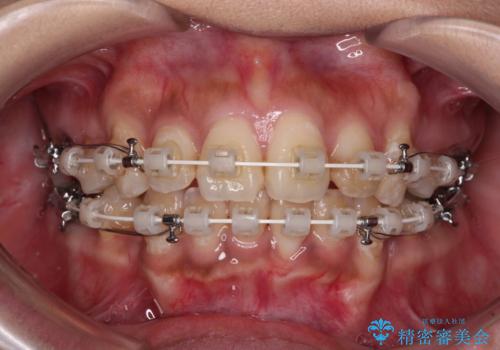 ワイヤー装置の抜歯矯正で横顔の口元の印象をすっきりとの治療中