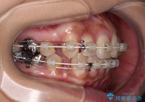 ワイヤー装置の抜歯矯正で横顔の口元の印象をすっきりとの治療中