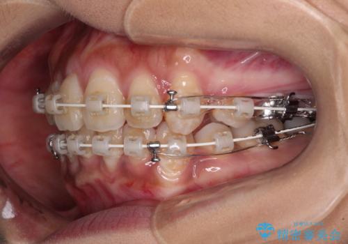 ワイヤー装置の抜歯矯正で横顔の口元の印象をすっきりとの治療中