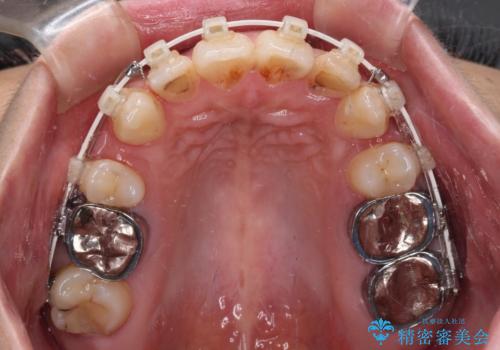 ワイヤー装置の抜歯矯正で横顔の口元の印象をすっきりとの治療中