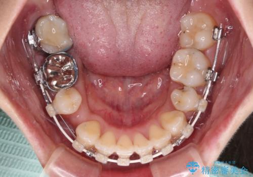 ワイヤー装置の抜歯矯正で横顔の口元の印象をすっきりとの治療中