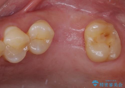 割れてしまった奥歯 サイナスリフトによるインプラント補綴治療の治療中