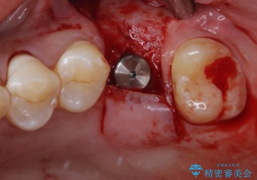 割れてしまった奥歯 サイナスリフトによるインプラント補綴治療の治療中