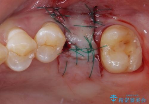 割れてしまった奥歯 サイナスリフトによるインプラント補綴治療の治療後