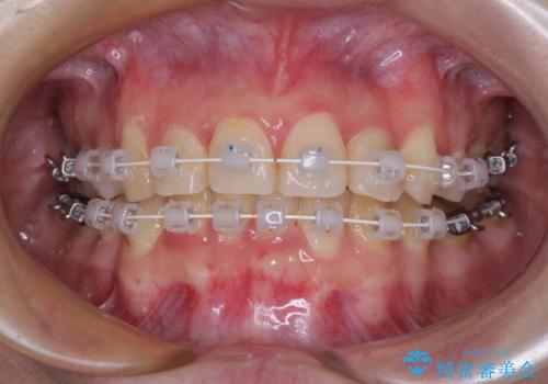 【モニター】再矯正でデコボコの前歯を改善 抜歯矯正の後戻りの治療中