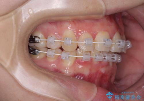 【モニター】再矯正でデコボコの前歯を改善 抜歯矯正の後戻りの治療中
