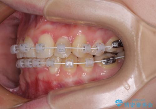【モニター】再矯正でデコボコの前歯を改善　抜歯矯正の後戻りの治療中