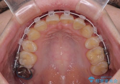 【モニター】再矯正でデコボコの前歯を改善　抜歯矯正の後戻りの治療中