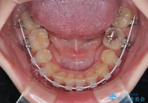 【モニター】再矯正でデコボコの前歯を改善 抜歯矯正の後戻りの治療中