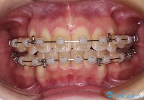 閉じにくい口元を抜歯矯正ですっきりとの治療中