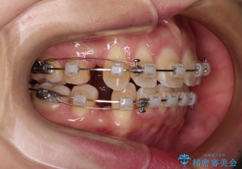 閉じにくい口元を抜歯矯正ですっきりとの治療中