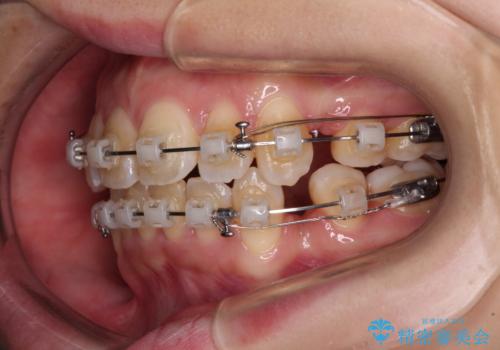 閉じにくい口元を抜歯矯正ですっきりとの治療中