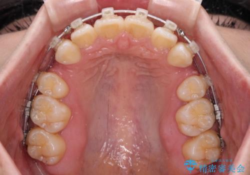 閉じにくい口元を抜歯矯正ですっきりとの治療中