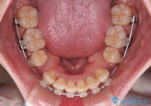 閉じにくい口元を抜歯矯正ですっきりとの治療中