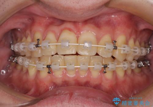 【モニター】前歯のデコボコとクロスバイト　ワイヤー矯正で短期間に仕上げるの治療中
