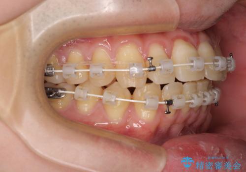 【モニター】前歯のデコボコとクロスバイト ワイヤー矯正で短期間に仕上げるの治療中
