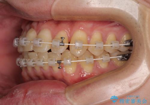 【モニター】前歯のデコボコとクロスバイト ワイヤー矯正で短期間に仕上げるの治療中