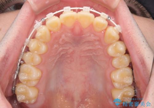 【モニター】前歯のデコボコとクロスバイト ワイヤー矯正で短期間に仕上げるの治療中
