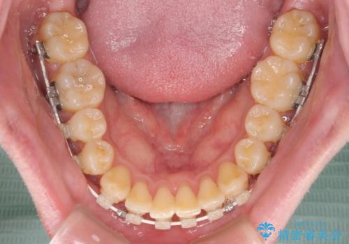 【モニター】前歯のデコボコとクロスバイト ワイヤー矯正で短期間に仕上げるの治療中