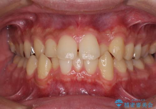 前歯のクロスバイト　インビザラインによる矯正治療の症例 治療前