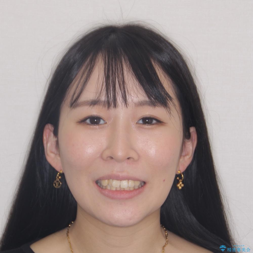 【モニター】八重歯を片側の抜歯矯正で治す メタルブラケット装置の治療前(顔貌)