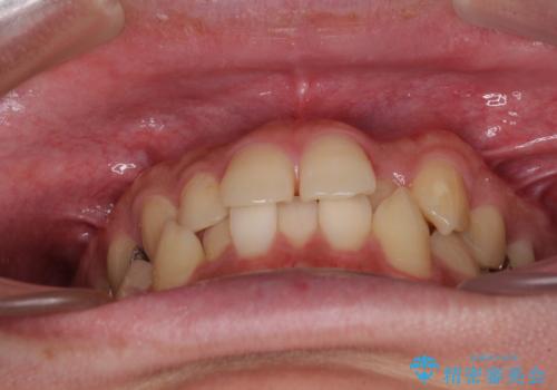 前歯のクロスバイト インビザラインによる矯正治療の治療前