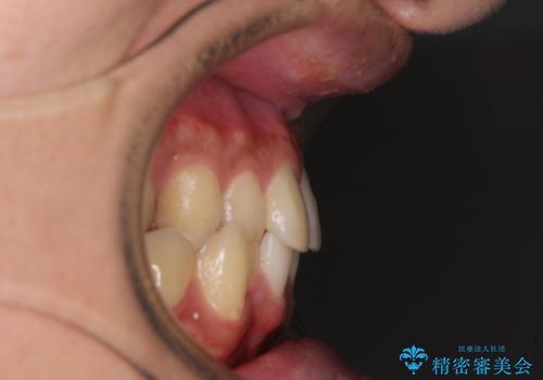 前歯のクロスバイト インビザラインによる矯正治療の治療前