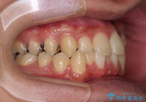 前歯のクロスバイト インビザラインによる矯正治療の治療前