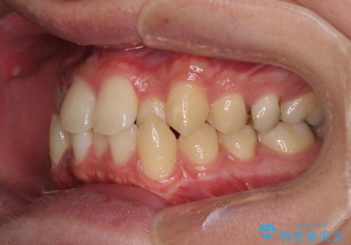 前歯のクロスバイト インビザラインによる矯正治療の治療前