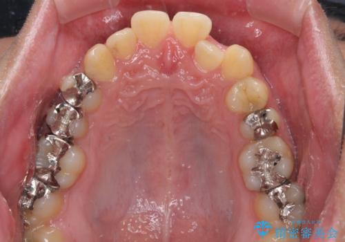 前歯のクロスバイト インビザラインによる矯正治療の治療前