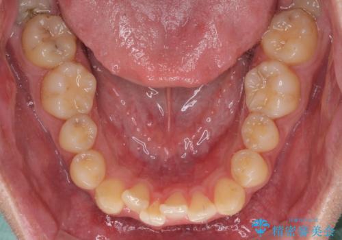 前歯のクロスバイト インビザラインによる矯正治療の治療前