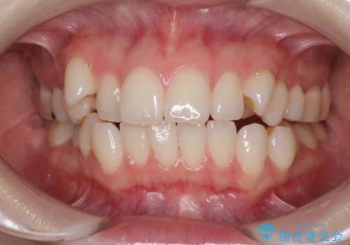 前歯のデコボコをインビザラインで改善の症例 治療前