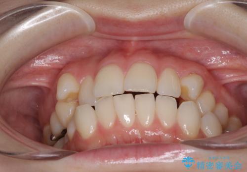 前歯のデコボコをインビザラインで改善の治療前