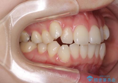 前歯のデコボコをインビザラインで改善の治療前