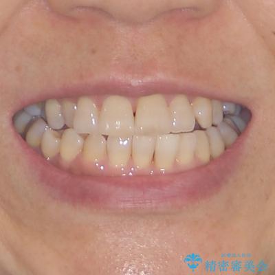 骨格のずれをカムフラージュ クロスバイトのワイヤー矯正の治療前(顔貌)