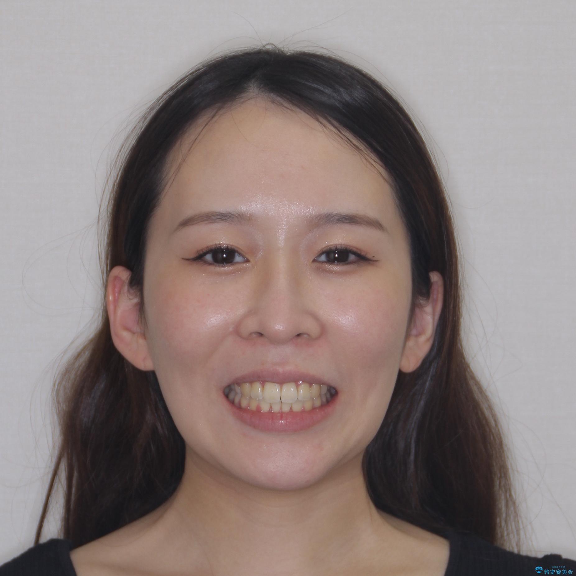 【モニター】八重歯を片側の抜歯矯正で治す メタルブラケット装置の治療後(顔貌)